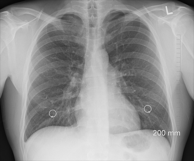 Inhalatoare presurizate vs. inhalatoare ultrasonice – care tip este potrivit pentru dumneavoastră?